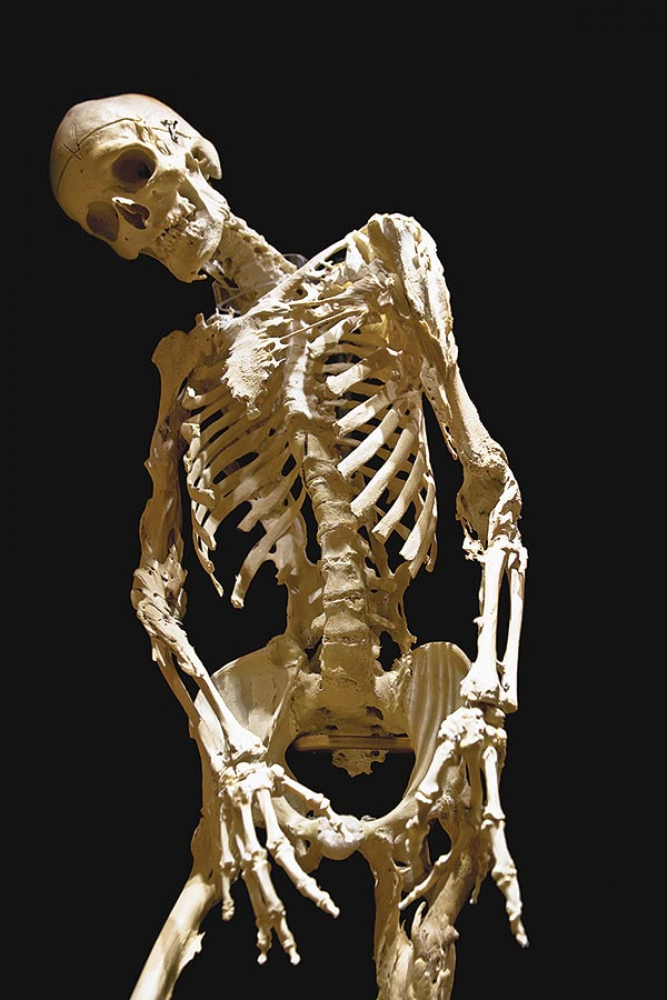 Kőember szindróma: más néven FOP betegség (fibrodysplasia ossificans progressiva). Jellemzője, hogy az izmok közötti kötőszövetek megcsontosodnak, így a beteg idővel „szoborrá” merevedik. Híres beteg: Harry Eastlack - Forrás: muttermuseum.org —  